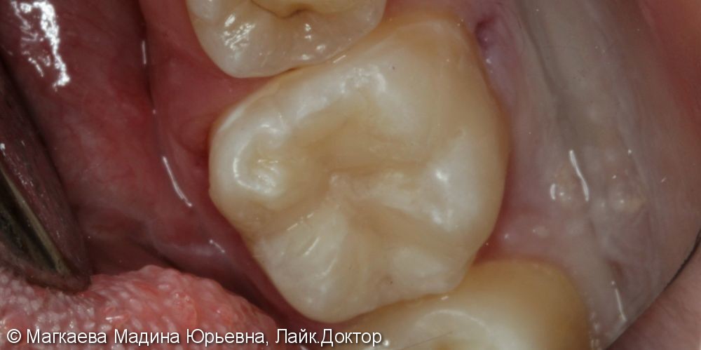 Лечение кариеса коренного зуба под микроскопом - фото №5