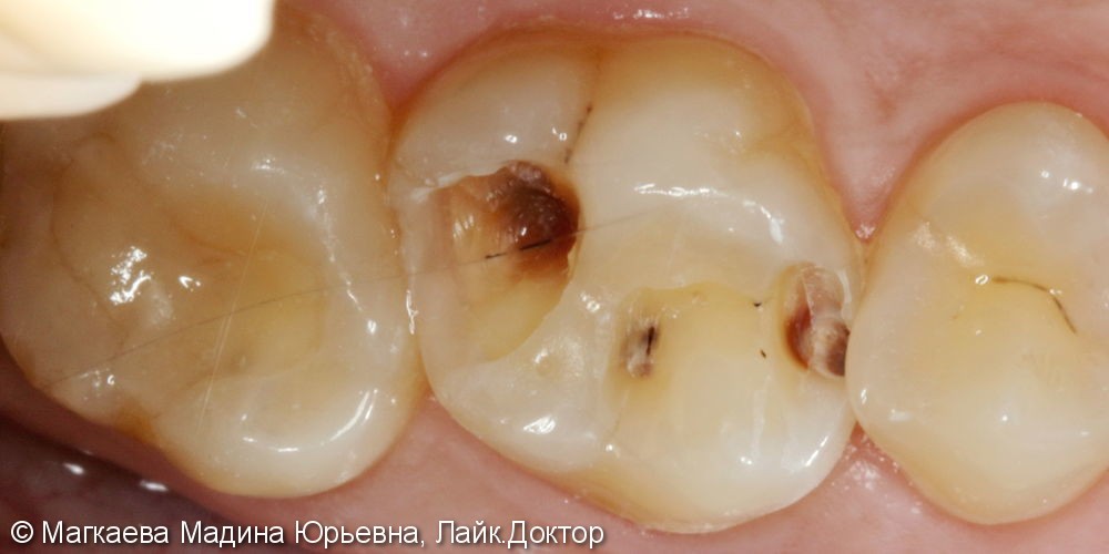 Лечение кариеса коренного зуба с применением кариес-маркера - фото №1