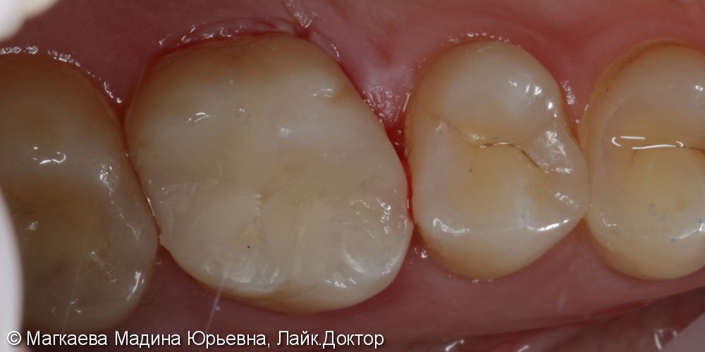 Лечение кариеса коренного зуба с применением кариес-маркера - фото №5
