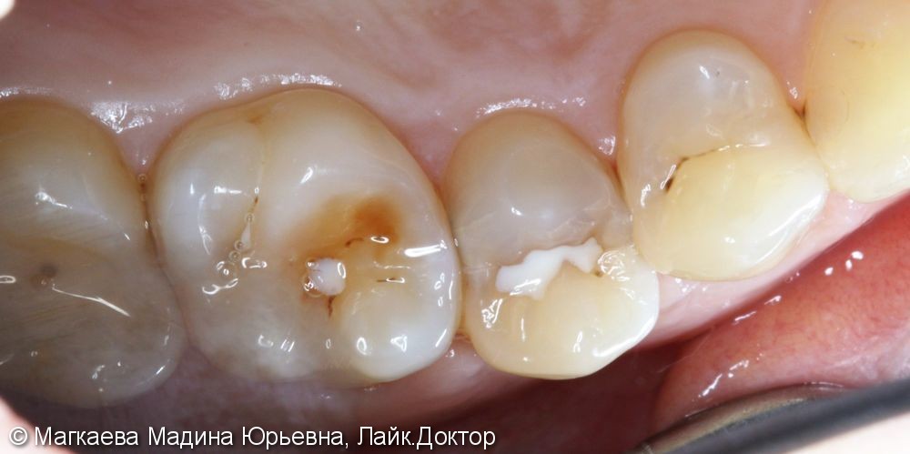 Лечение кариеса передних зубов - фото №1