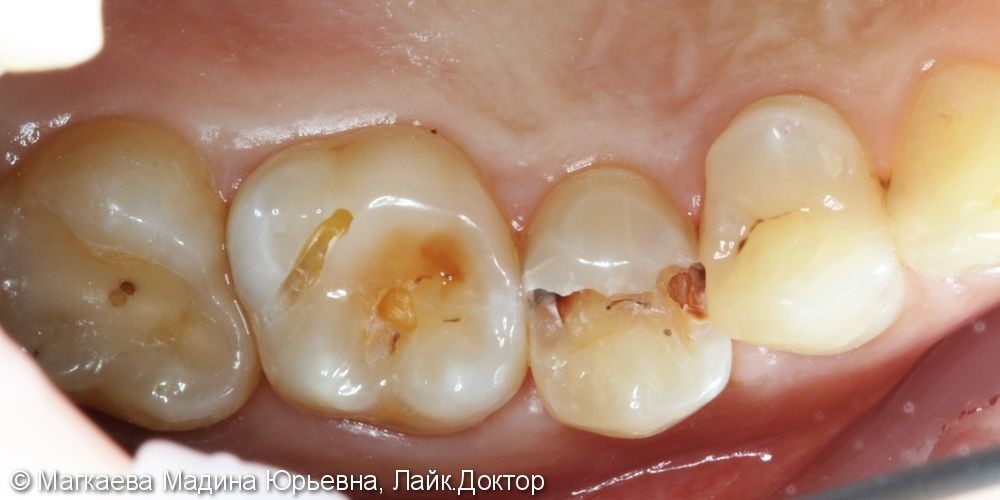 Лечение кариеса передних зубов - фото №2