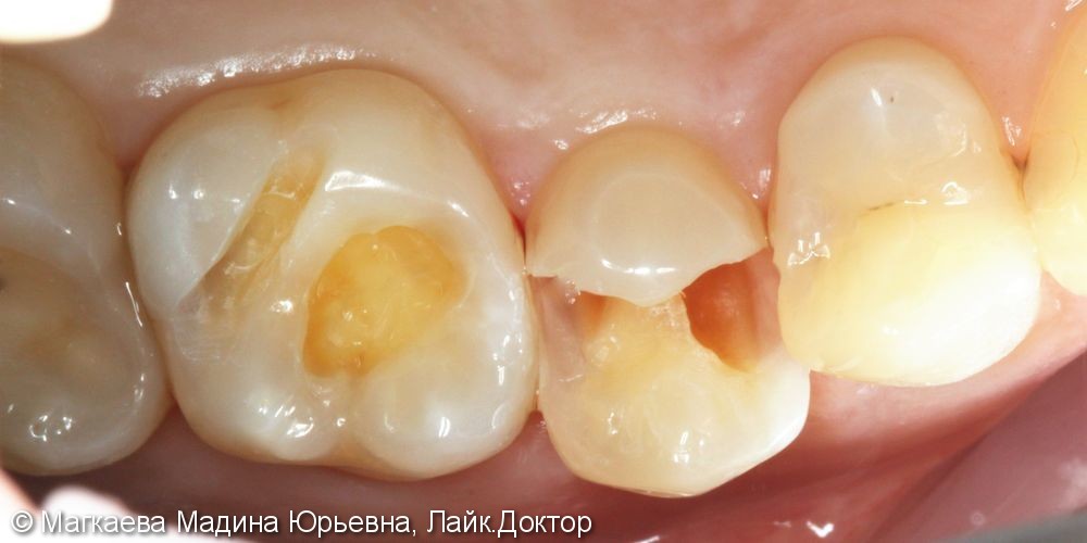 Лечение кариеса передних зубов - фото №3