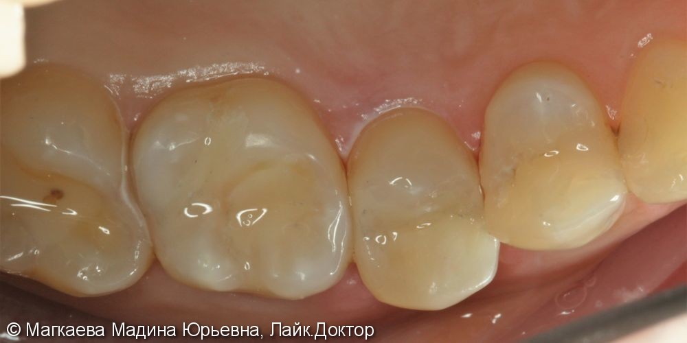Лечение кариеса передних зубов - фото №4