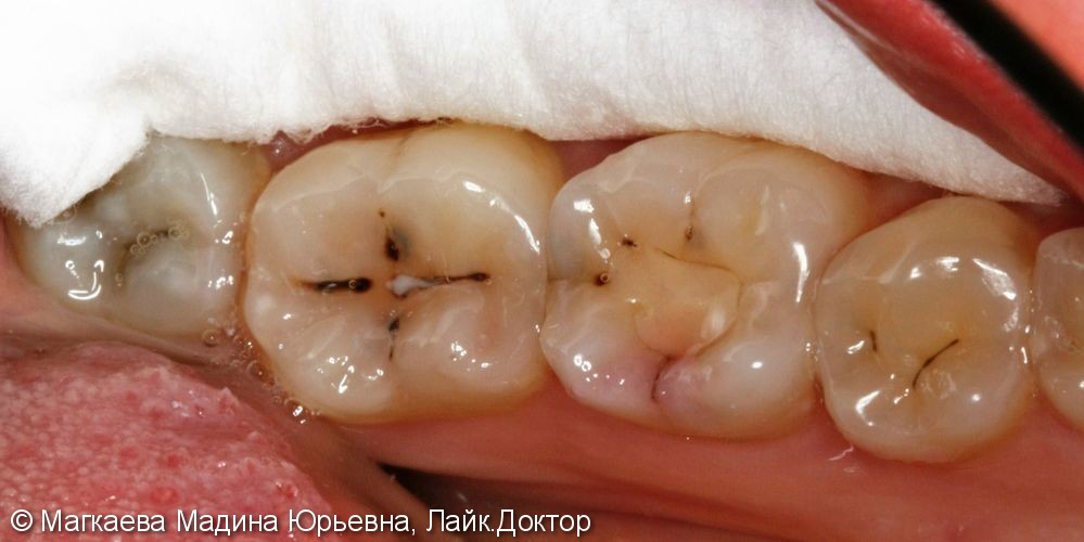 Лечение кариеса зубов нижней челюсти - фото №1