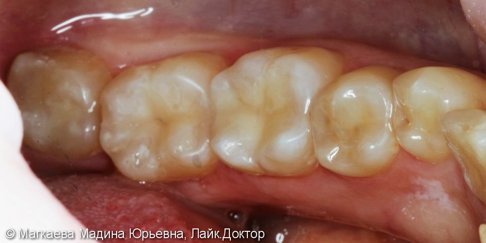 Лечение кариеса зубов нижней челюсти - фото №4