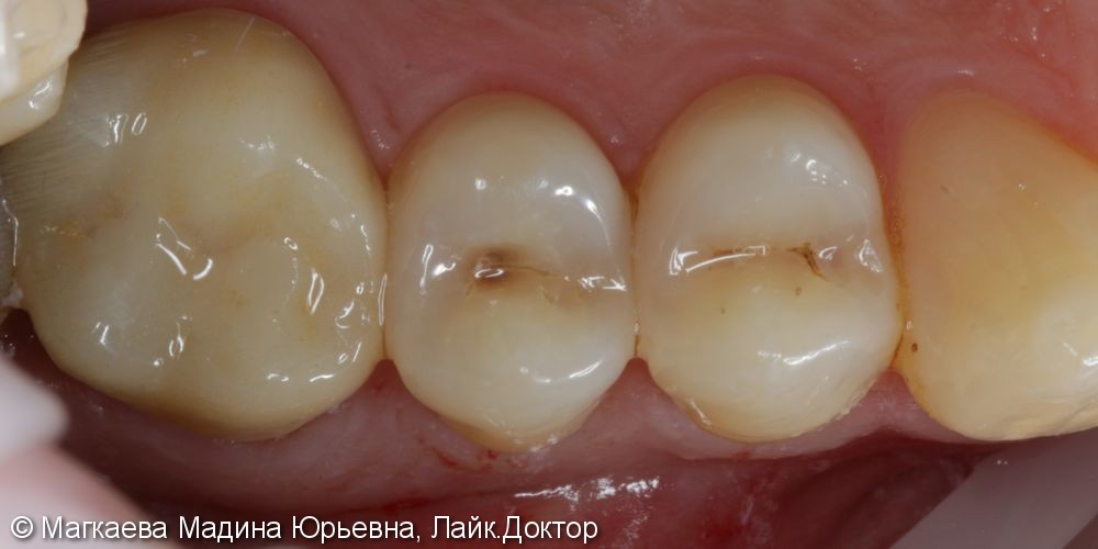 Лечение кариеса зубов нижней челюсти - фото №1