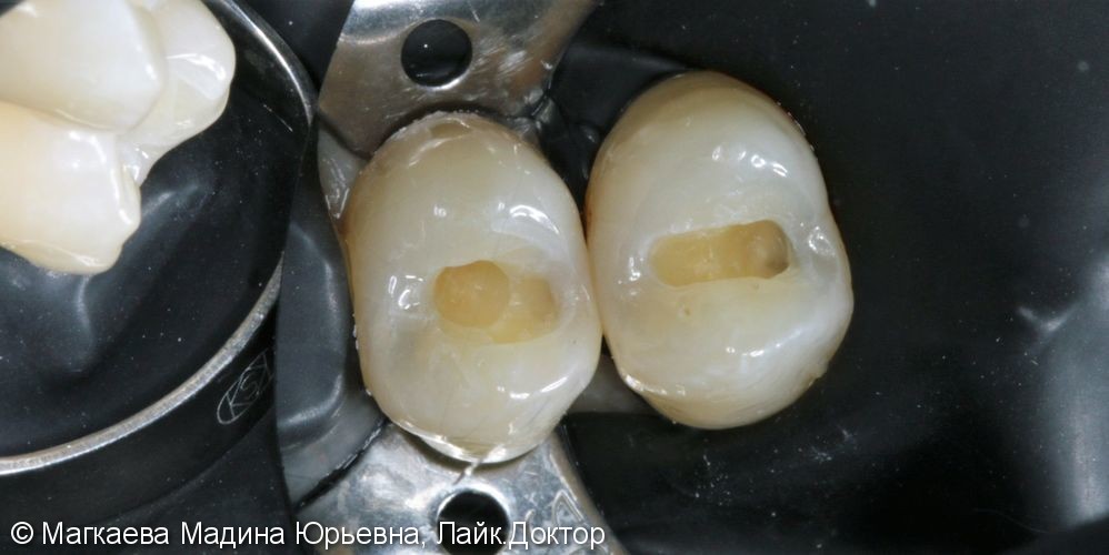 Лечение кариеса зубов нижней челюсти - фото №2