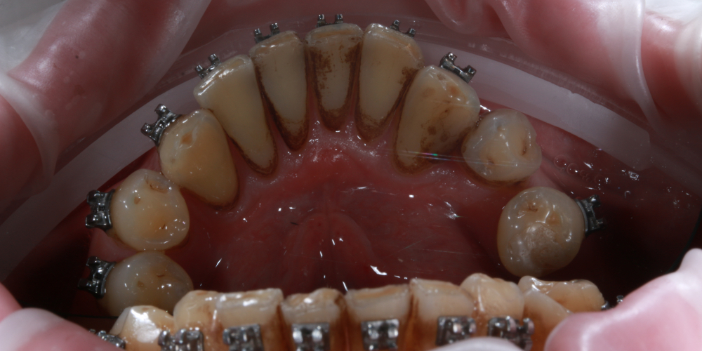 Профессиональная гигиена полости рта в процессе ортодонтического лечения - фото №1