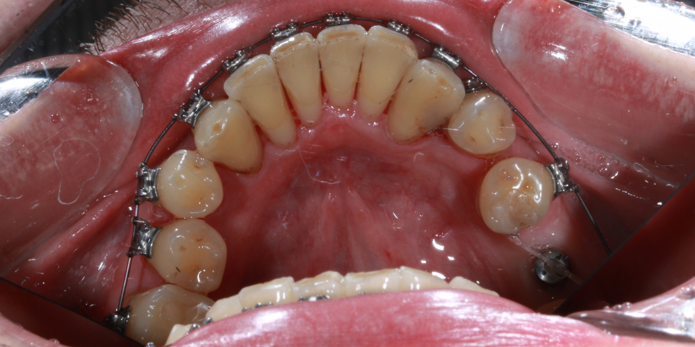 Профессиональная гигиена полости рта в процессе ортодонтического лечения - фото №2