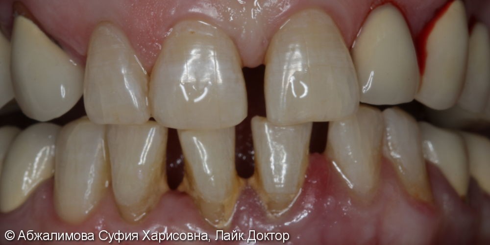 Ультразвуковая чистка зубов, до и после - фото №1