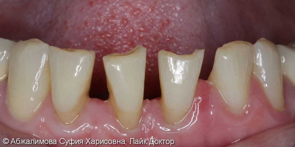 Ультразвуковая чистка зубов, до и после - фото №5
