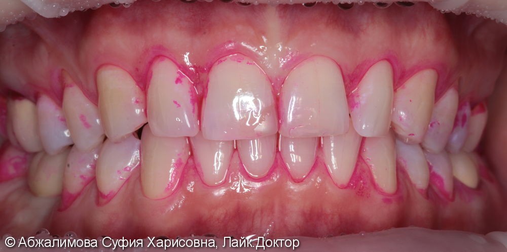 Профессиональная гигиена полости рта Curaprox 260, GC Tooth Mousse - фото №1