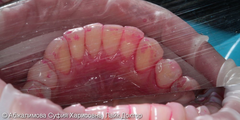 Профессиональная гигиена полости рта Curaprox 260, GC Tooth Mousse - фото №3