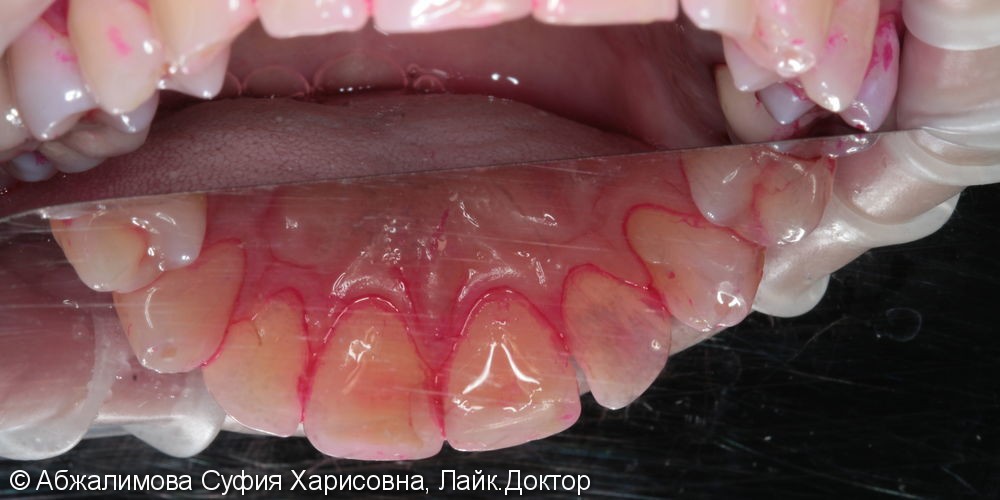 Профессиональная гигиена полости рта Curaprox 260, GC Tooth Mousse - фото №4