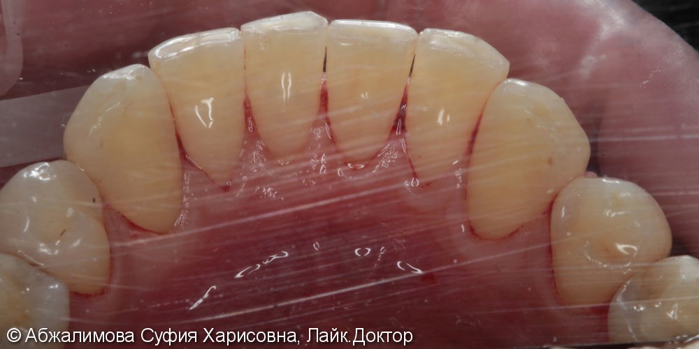 Профессиональная гигиена полости рта Curaprox 260, GC Tooth Mousse - фото №6