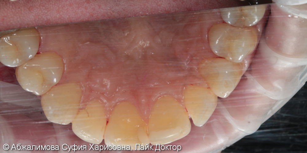 Профессиональная гигиена полости рта Curaprox 260, GC Tooth Mousse - фото №7