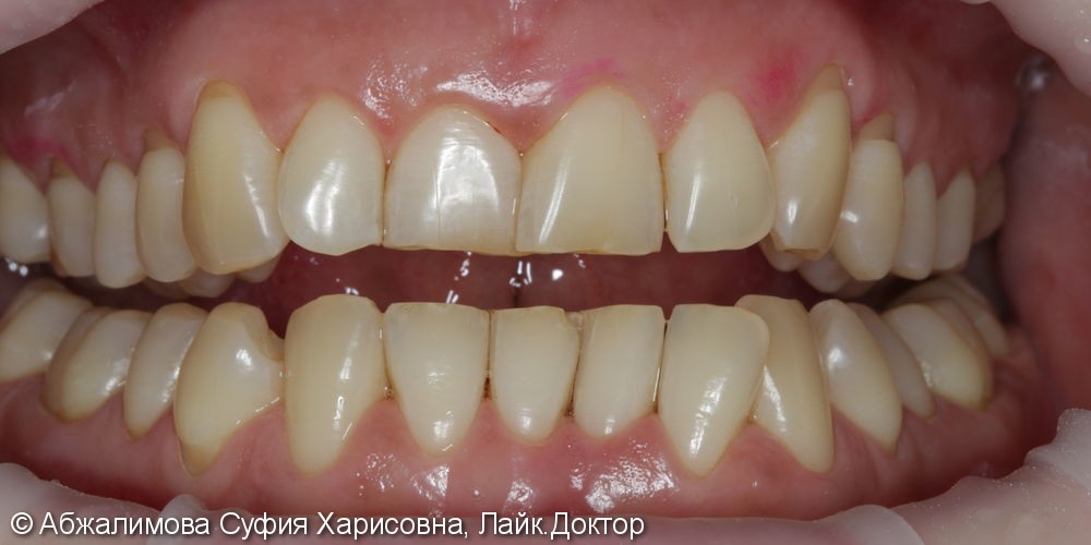 Профессиональная гигиена против налета от сигарет на зубах - фото №8