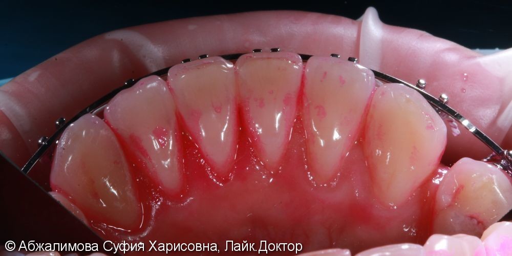 Комплексная гигиена полости рта при прохождении ортодонтического лечения - фото №1