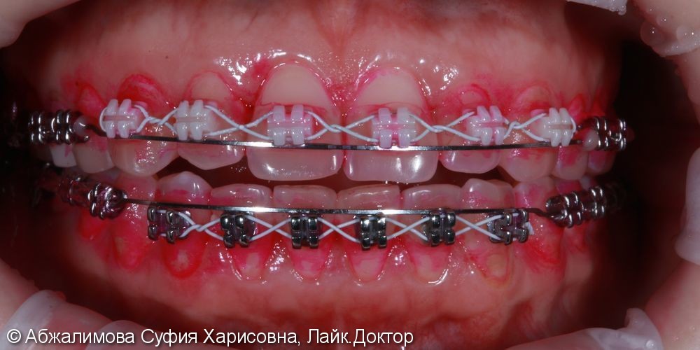 Комплексная гигиена полости рта при прохождении ортодонтического лечения - фото №2