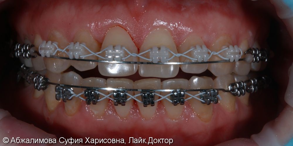 Комплексная гигиена полости рта при прохождении ортодонтического лечения - фото №3