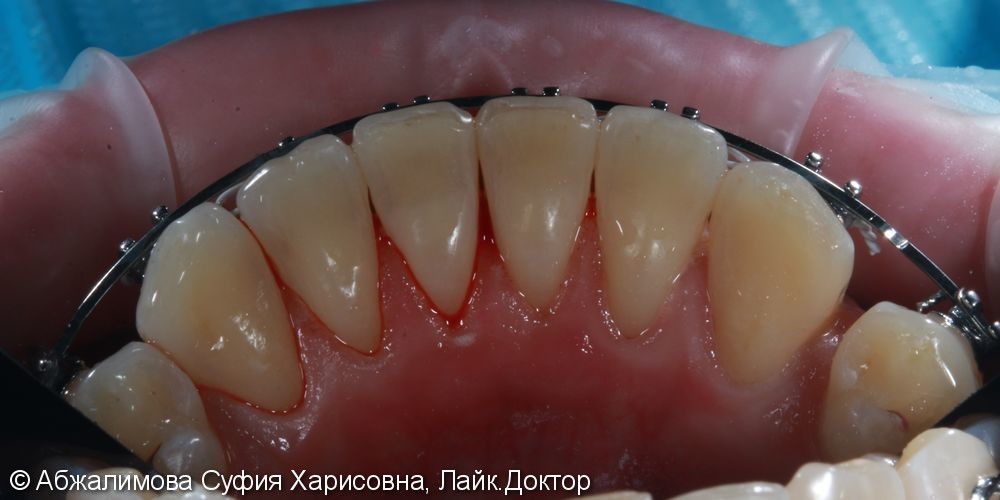 Комплексная гигиена полости рта при прохождении ортодонтического лечения - фото №4