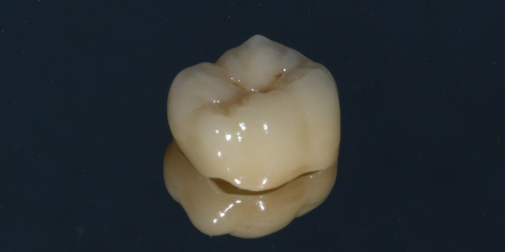 Протезирование жевательного зуба безметалловой коронкой - фото №4