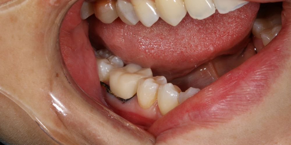 Протезирование жевательного зуба безметалловой коронкой - фото №2