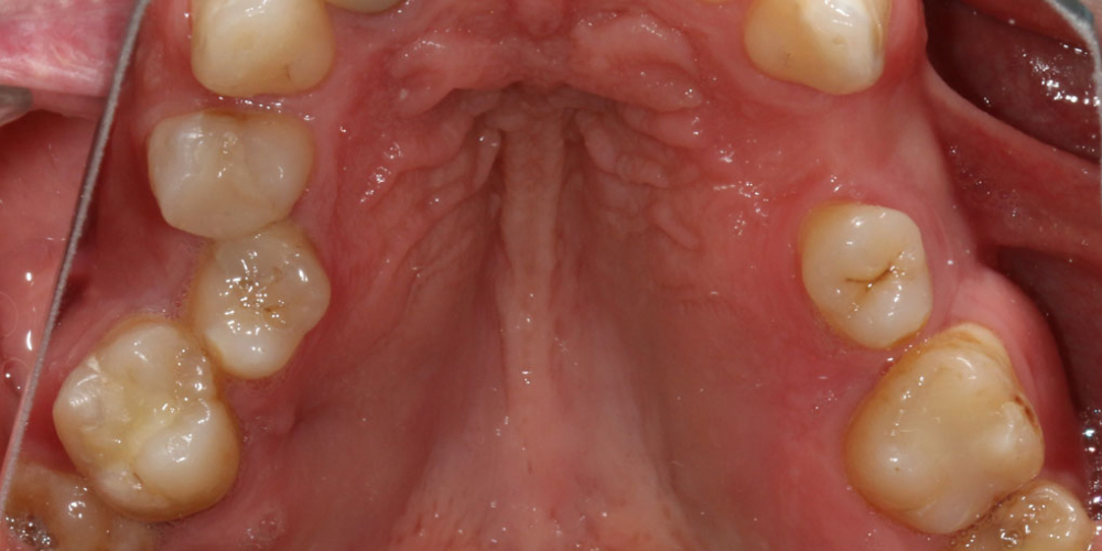 Восстановление жевателньых зубов (имплантация MIS Seven, безметалловые коронки) - фото №3