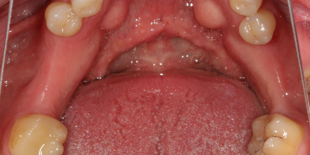 Восстановление жевателньых зубов (имплантация MIS Seven, безметалловые коронки) - фото №4