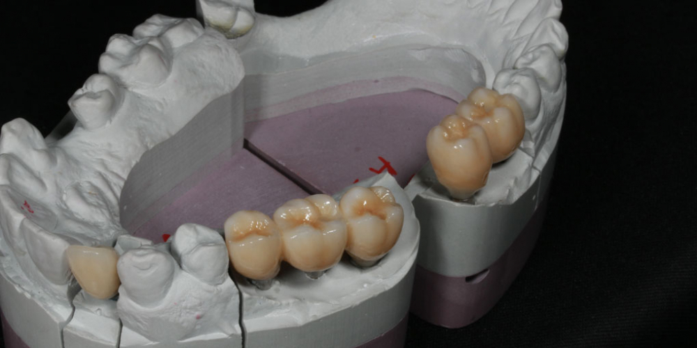 Восстановление жевателньых зубов (имплантация MIS Seven, безметалловые коронки) - фото №5