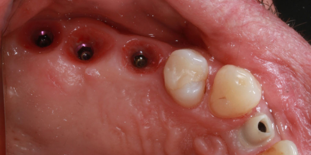 Восстановление жевателньых зубов (имплантация MIS Seven, безметалловые коронки) - фото №6