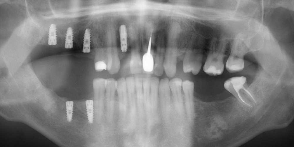 Восстановление жевателньых зубов (имплантация MIS Seven, безметалловые коронки) - фото №7