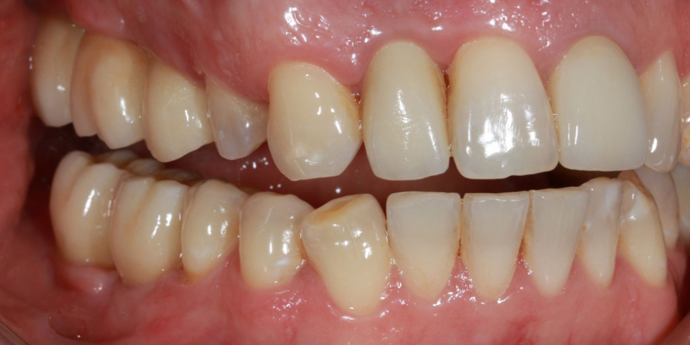 Восстановление жевателньых зубов (имплантация MIS Seven, безметалловые коронки) - фото №2