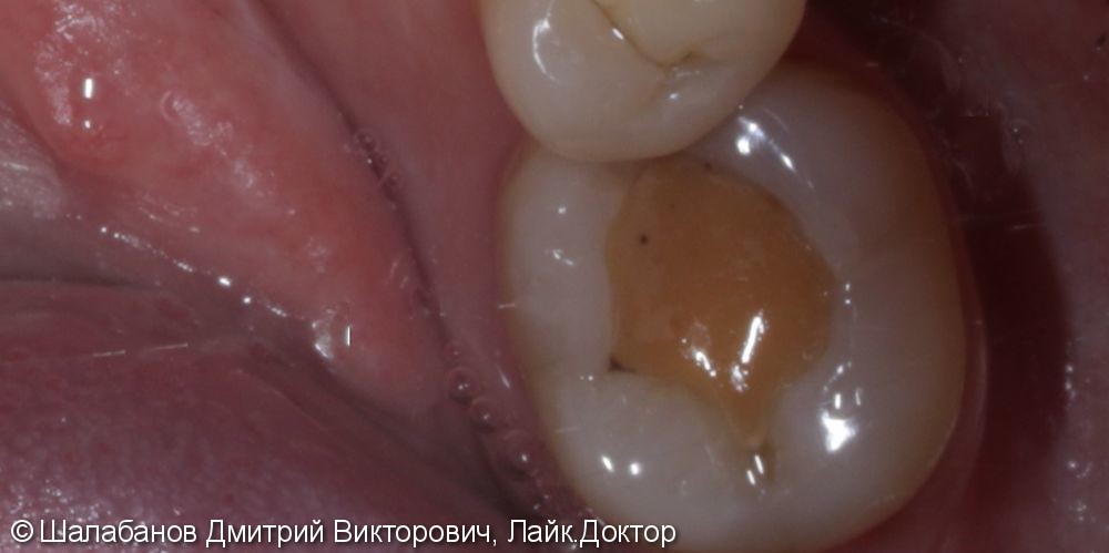 Восстановление прикуса зуба цельнокерамической коронкой - фото №2