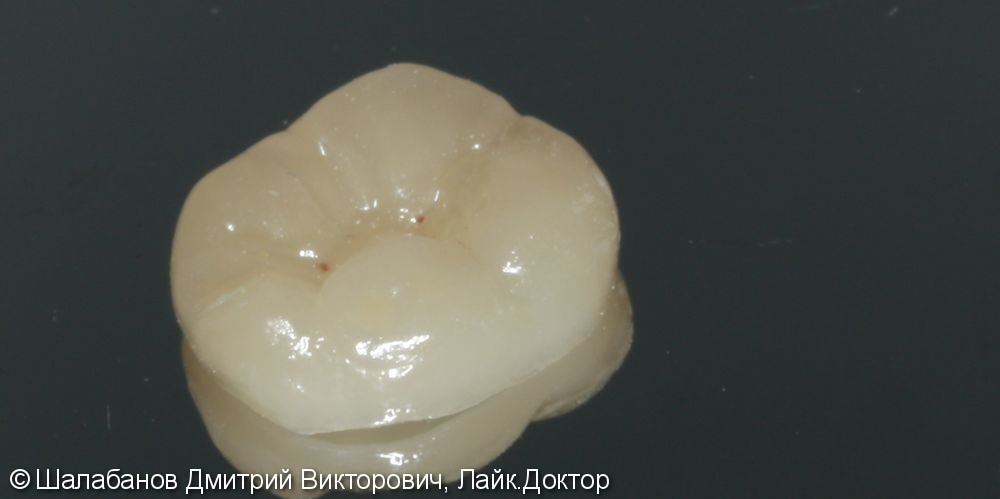 Восстановление прикуса зуба цельнокерамической коронкой - фото №3