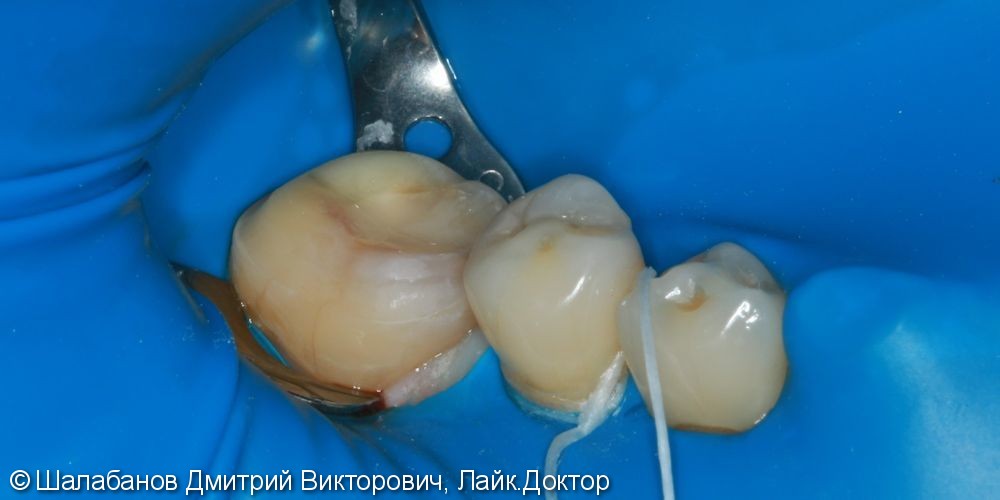 Восстановление прикуса зуба цельнокерамической коронкой - фото №4