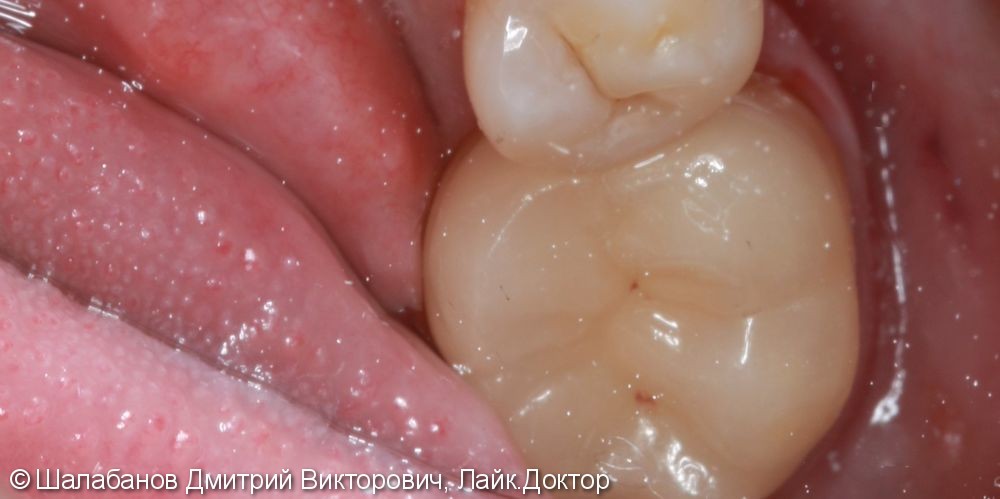 Восстановление прикуса зуба цельнокерамической коронкой - фото №5