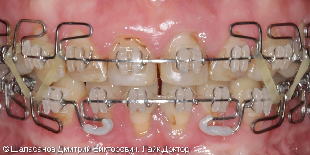 Эстетическая реставрация зубов - фото №5