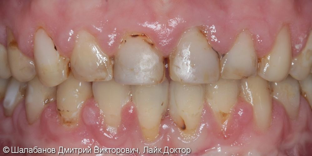 Эстетическая реставрация зубов - фото №6
