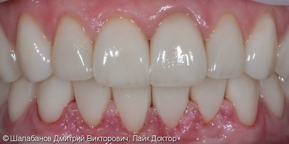 Эстетическая реставрация зубов - фото №9