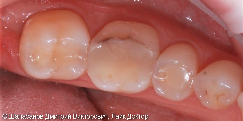 Реставрация зубов цельнокерамическими микропротезами - фото №1