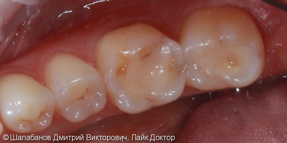 Реставрация зубов цельнокерамическими микропротезами - фото №2