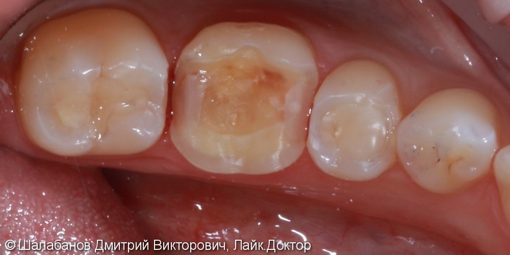 Реставрация зубов цельнокерамическими микропротезами - фото №3