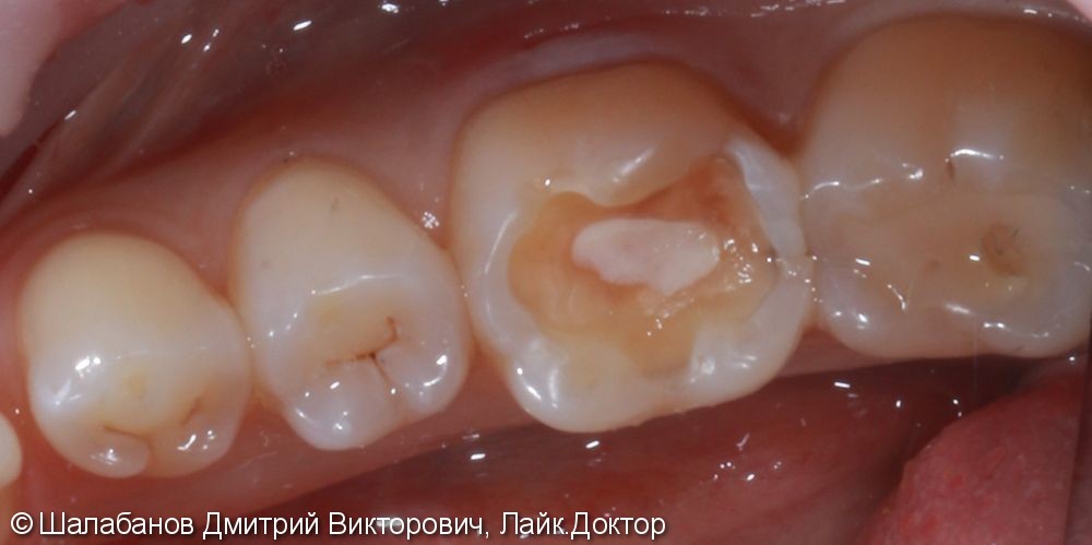 Реставрация зубов цельнокерамическими микропротезами - фото №4