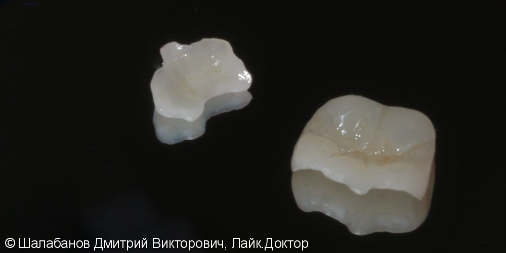 Реставрация зубов цельнокерамическими микропротезами - фото №7