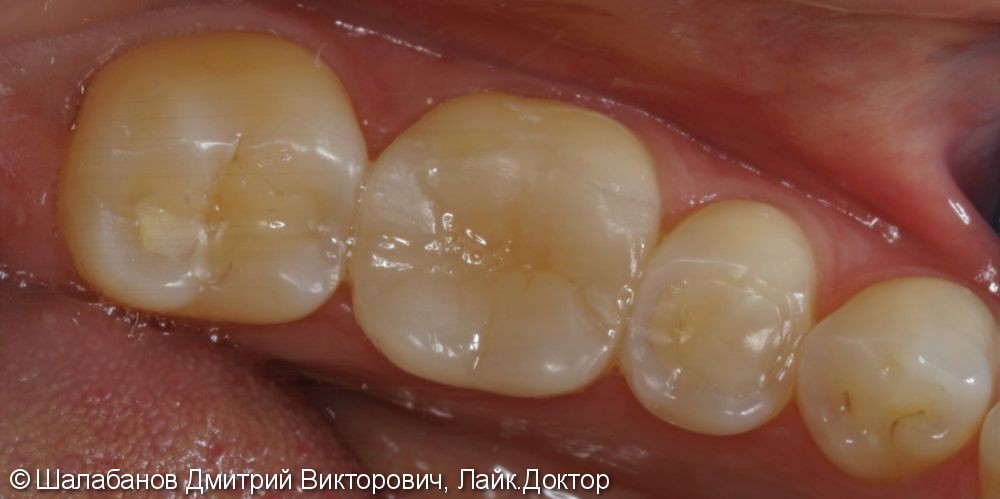 Реставрация зубов цельнокерамическими микропротезами - фото №8