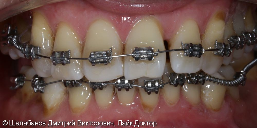 Исправление прикуса с установкой коронок на импланты и зубы - фото №4