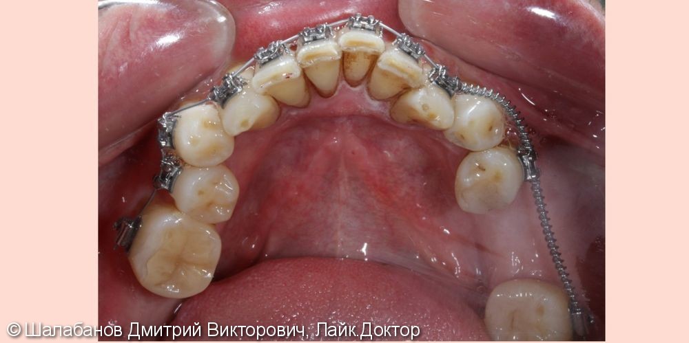 Исправление прикуса с установкой коронок на импланты и зубы - фото №6