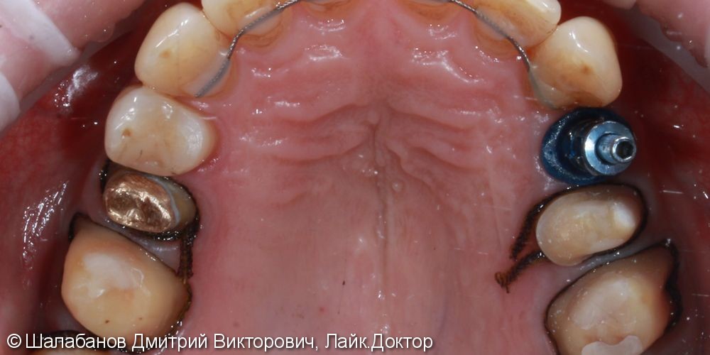 Исправление прикуса с установкой коронок на импланты и зубы - фото №7
