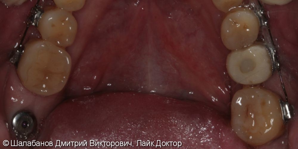 Исправление прикуса с установкой коронок на импланты и зубы - фото №8
